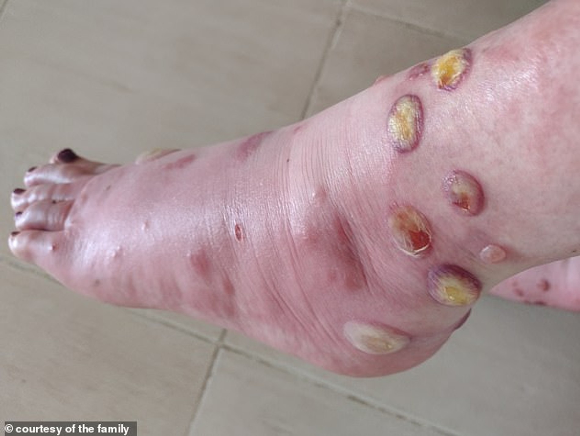 Волдыри, образовавшиеся на ногах Трейси от укусов комаров
Фото: Daily Mail