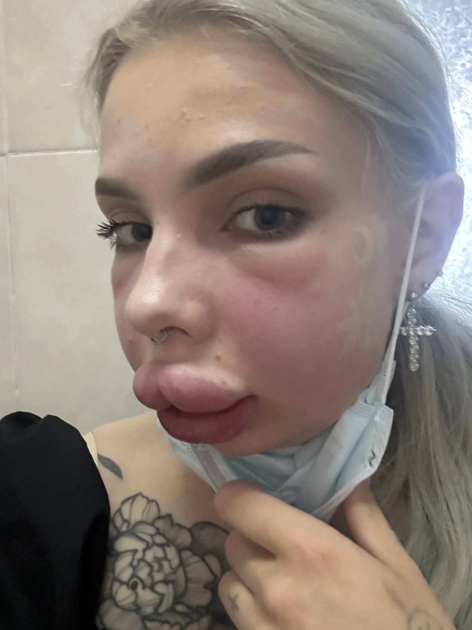 Отек начинает спадать
Фото: Telegram-канал Картье Бугатти