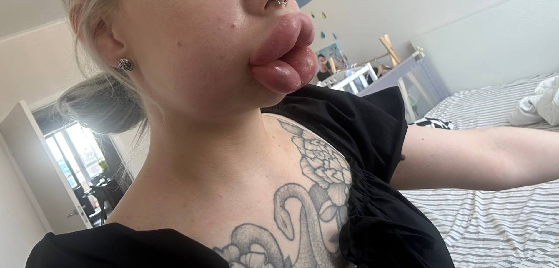 Так выглядел отек в самом начале
Фото: Telegram-канал Картье Бугатти