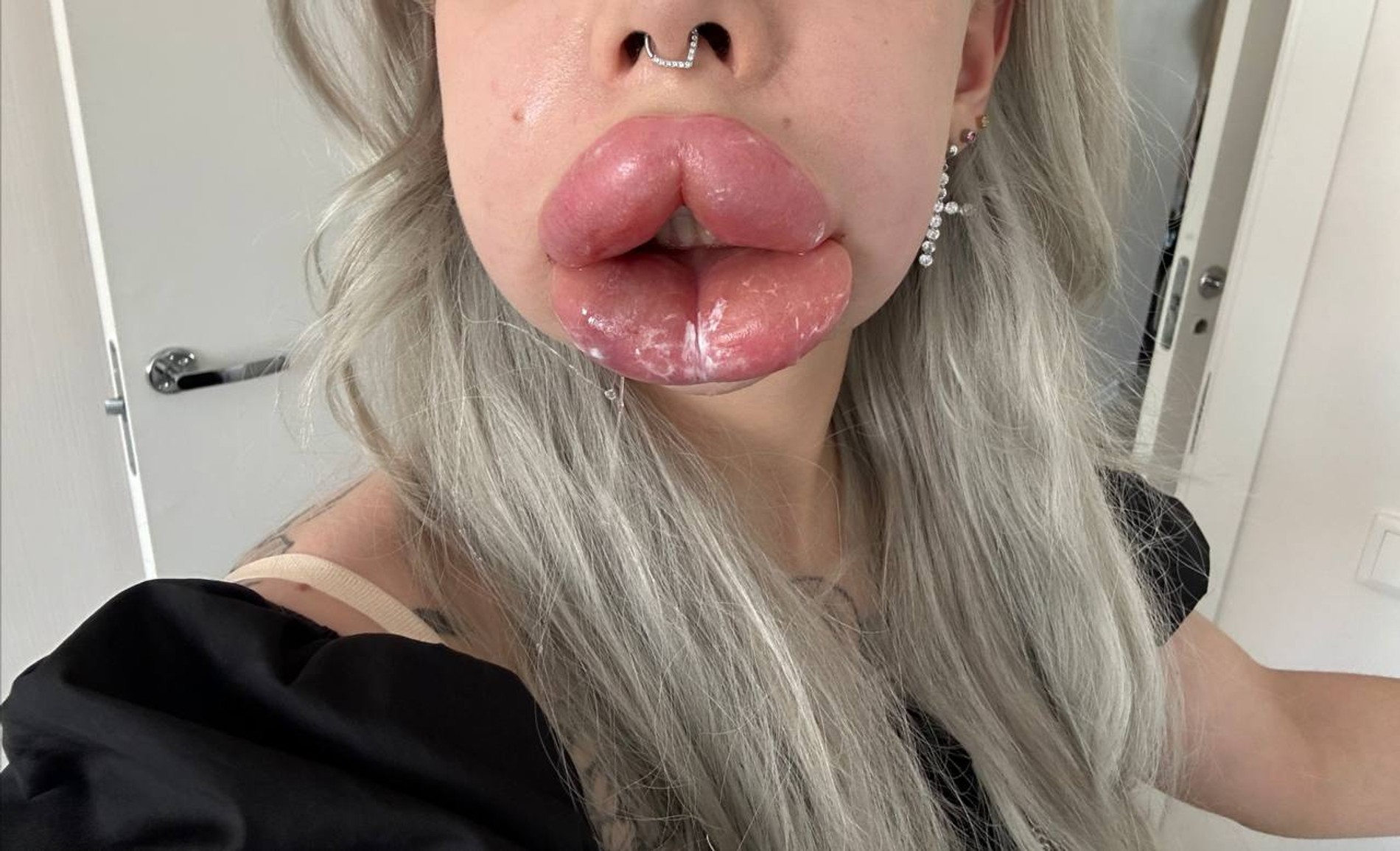 Так выглядел отек в самом начале
Фото: Telegram-канал Картье Бугатти