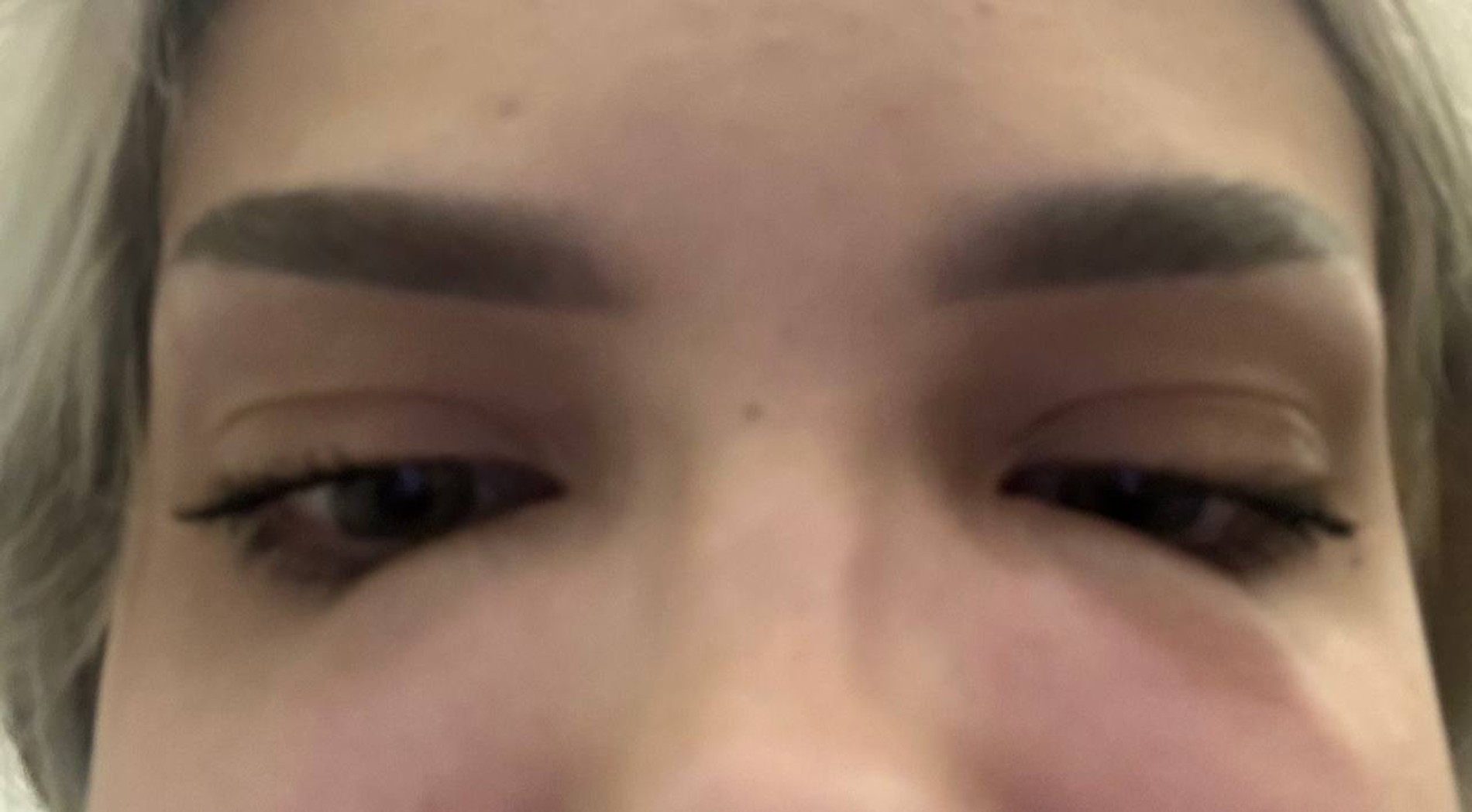 Так выглядел отек в самом начале
Фото: Telegram-канал Картье Бугатти