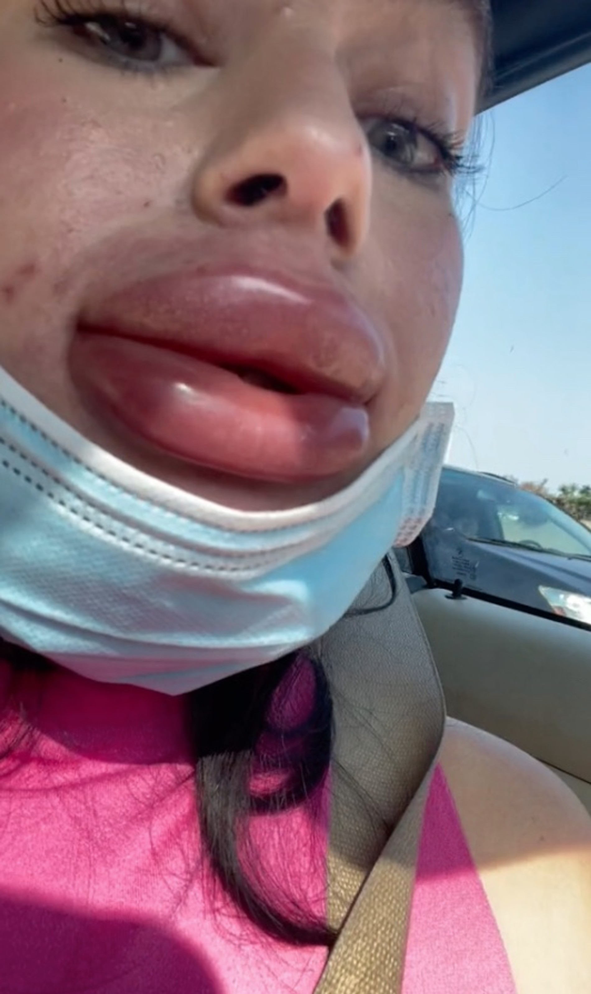 Результат неудачной инъекции филлера
Фото: Тикток @jessicacaileyburko