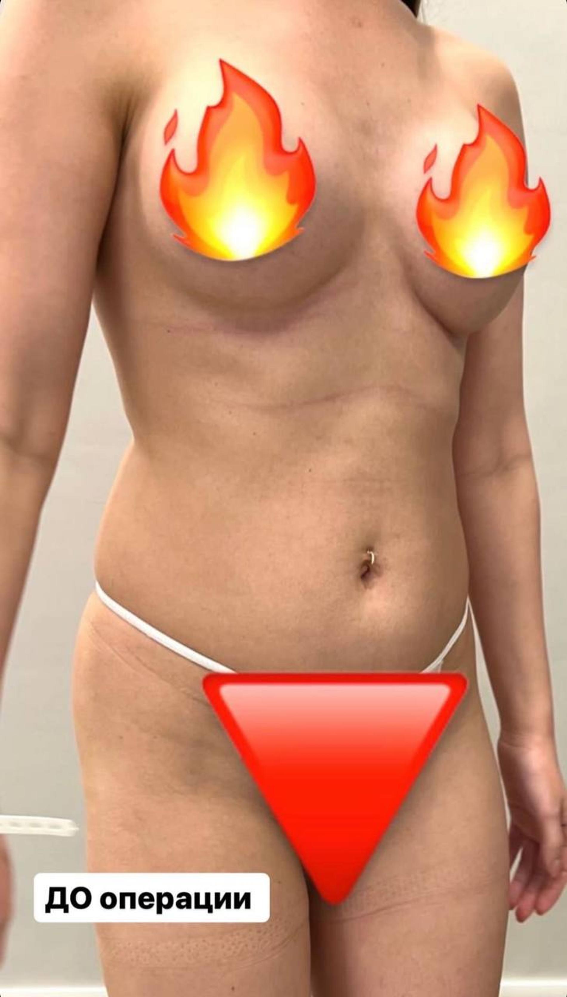 Светлана Сильваши до липосакции. Фото: Инстаграм* @silvashi_officiel